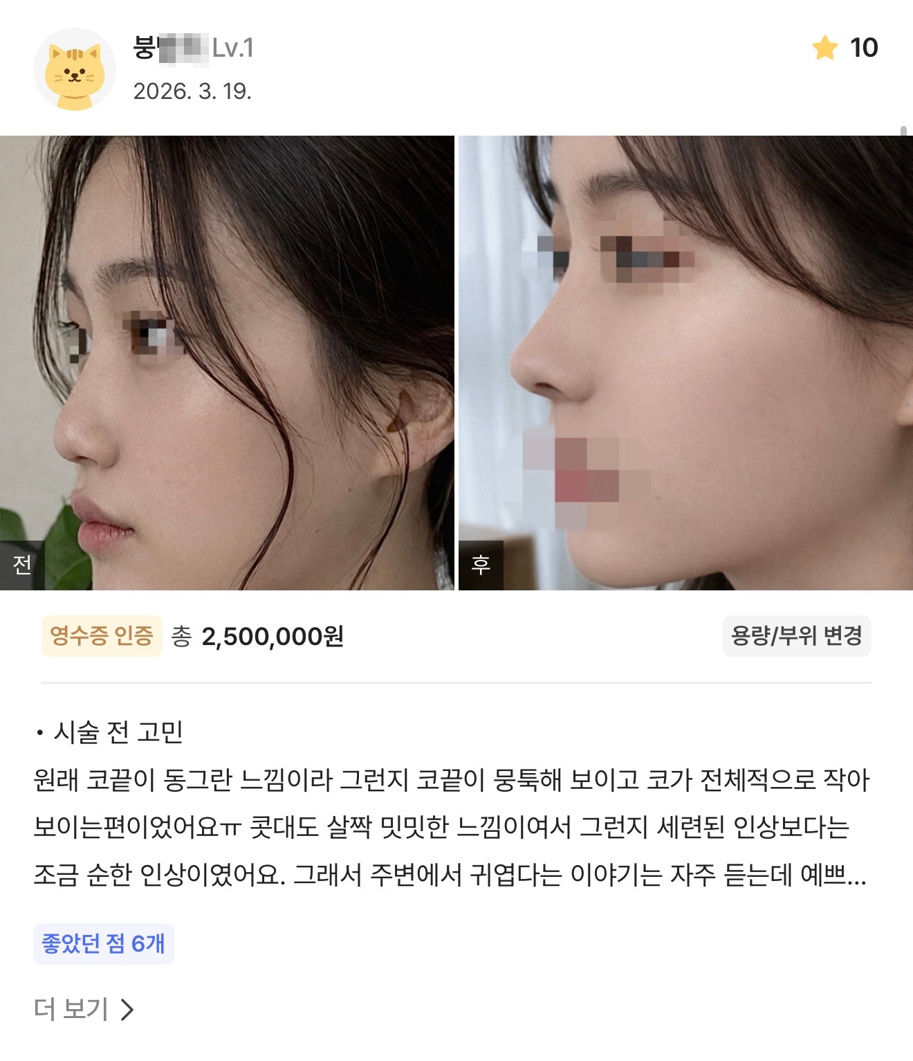 강남언니 게재 환자 후기 1