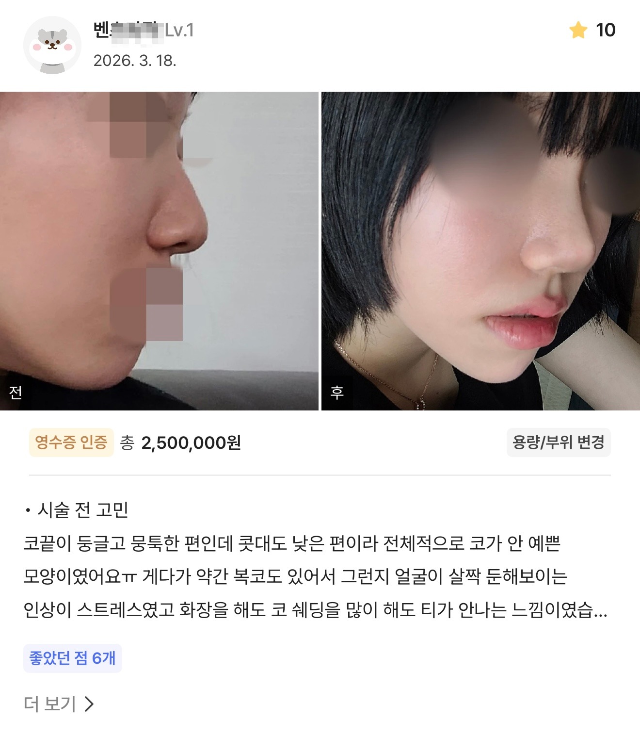 강남언니 게재 환자 후기 2