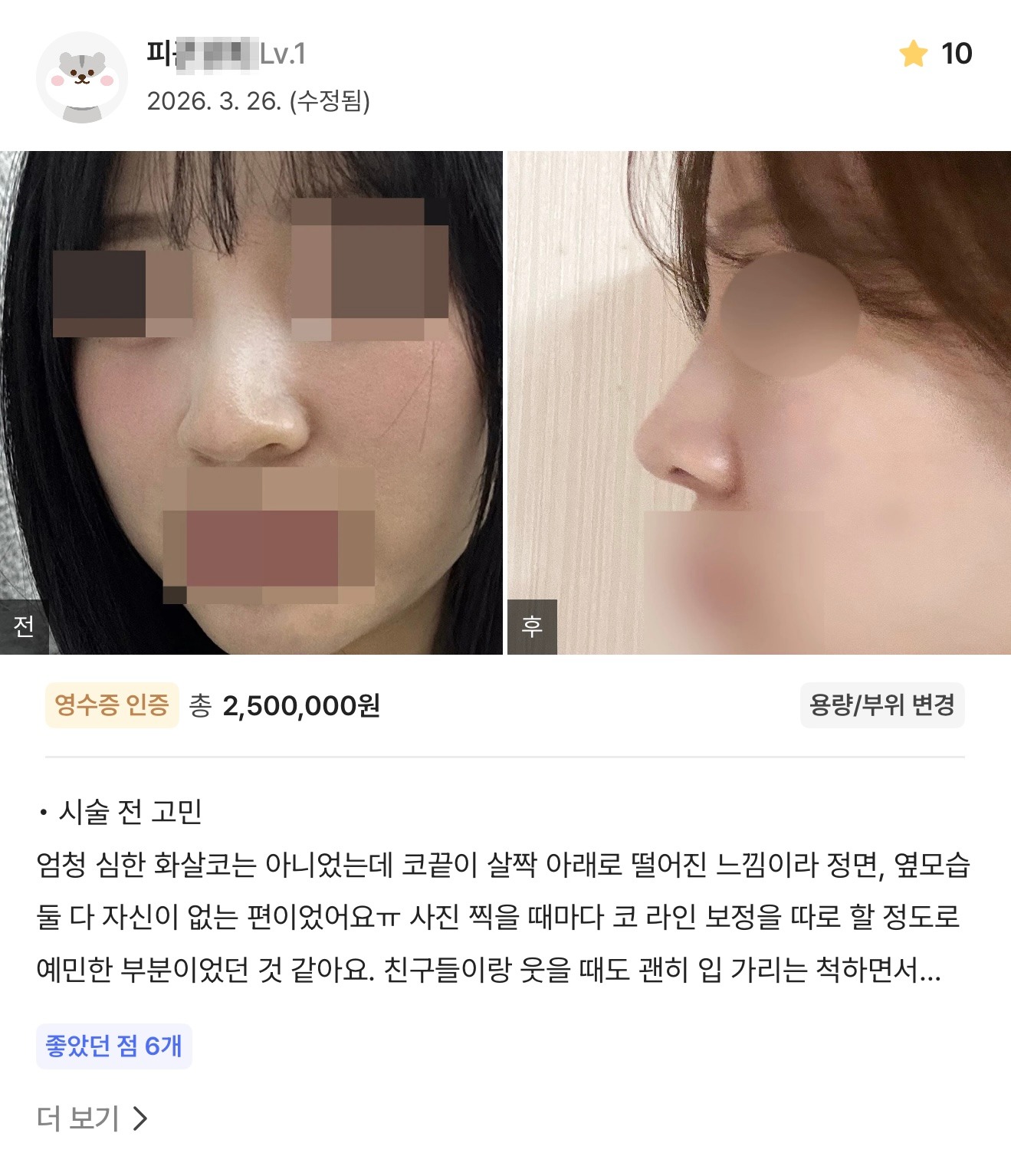 강남언니 게재 환자 후기 4