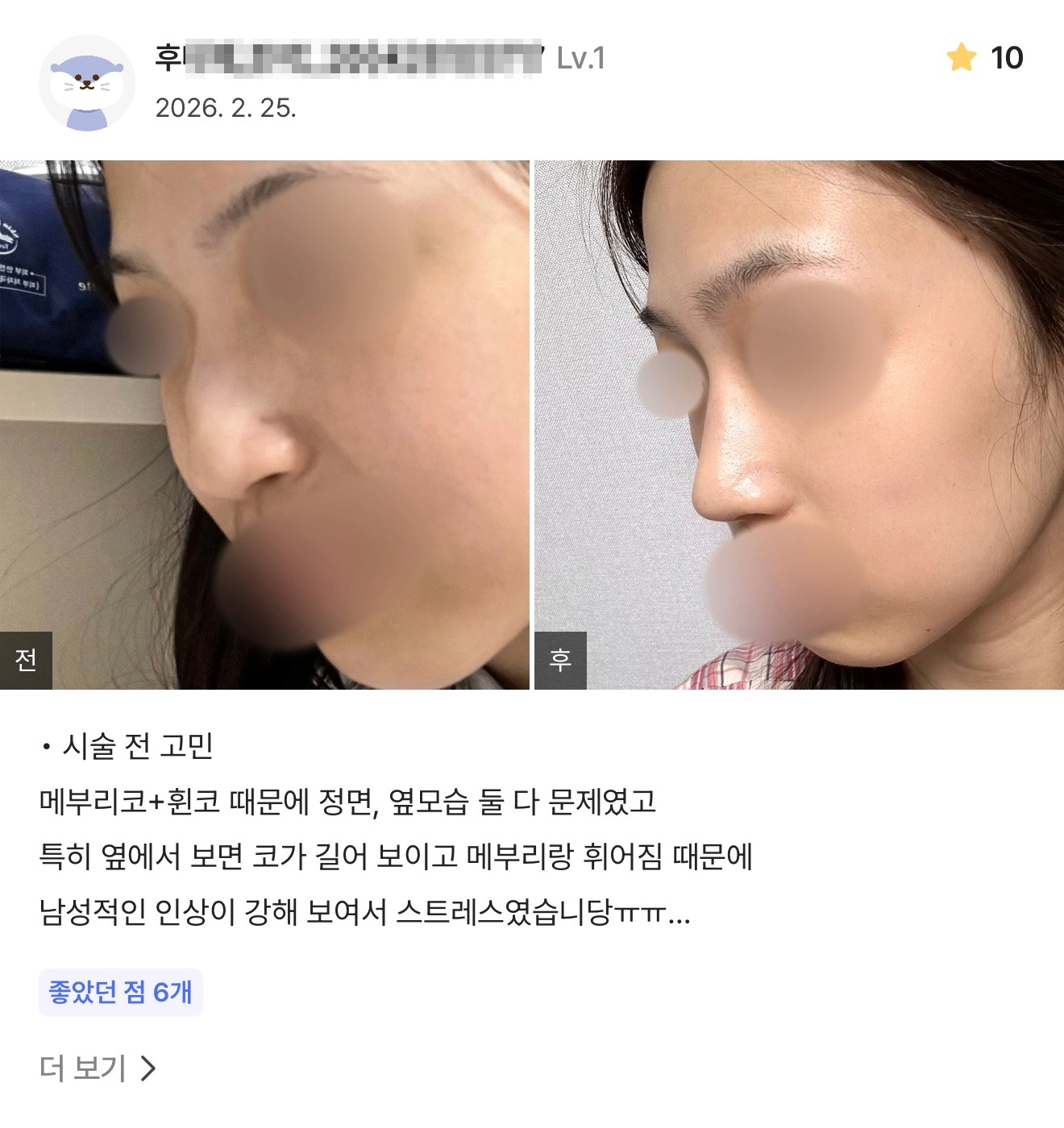 강남언니 게재 환자 후기 6